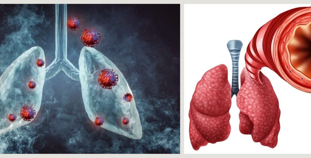 Bronchitis Symptoms and Contagiousness: What to Watch for and When to Seek Care