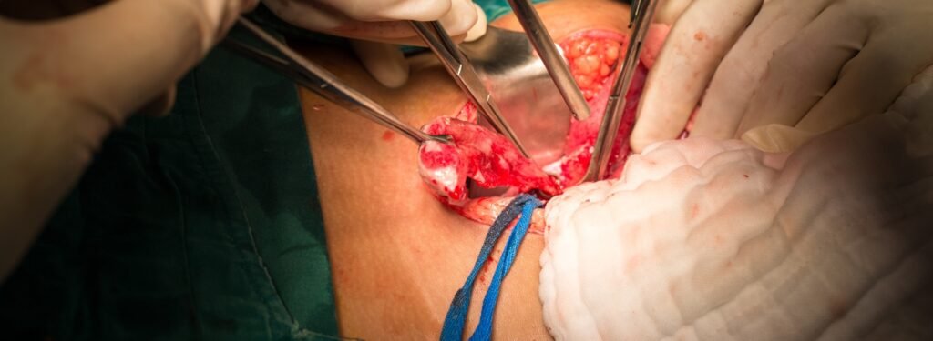 what happens if your appendix bursts