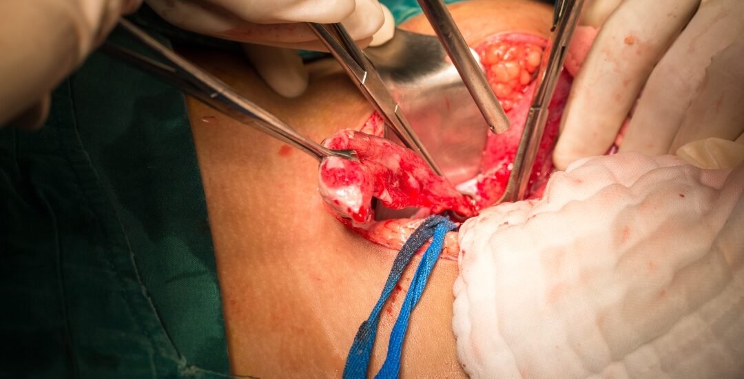 what happens if your appendix bursts
