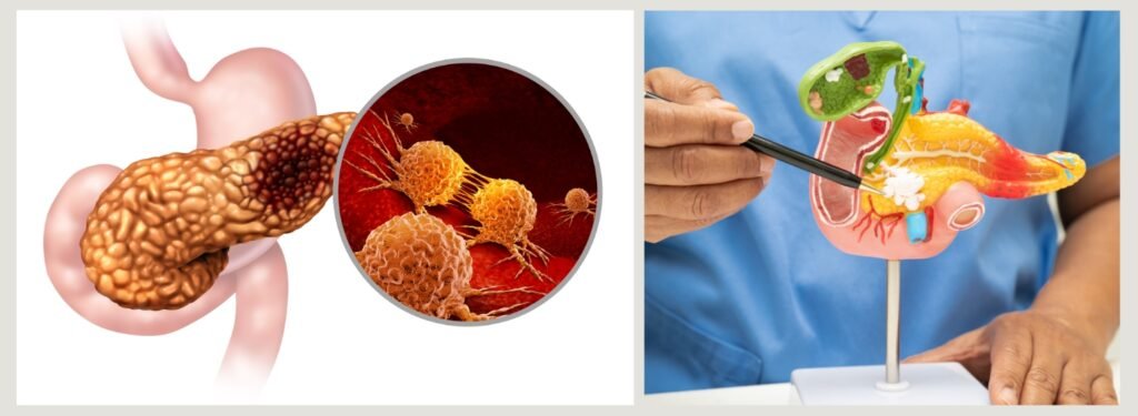 pancreatic adenocarcinoma causes