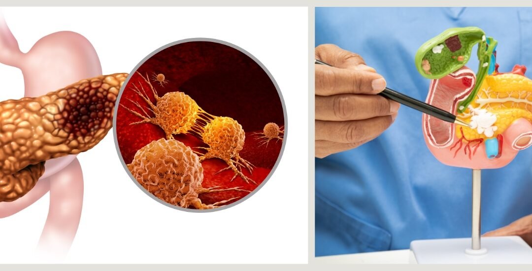pancreatic adenocarcinoma causes