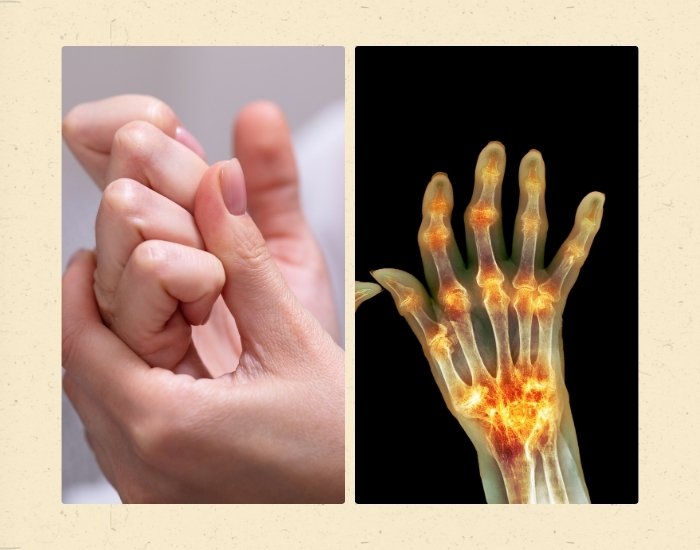 Does Popping Your Fingers Give You Arthritis