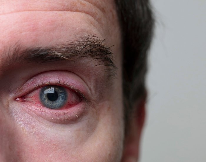 How to Get a Pink Eye