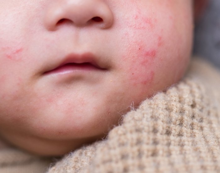 Slapped Cheek Fifth Disease