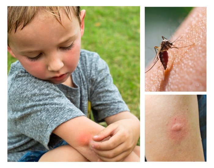 Bug Bites Pictures Identification