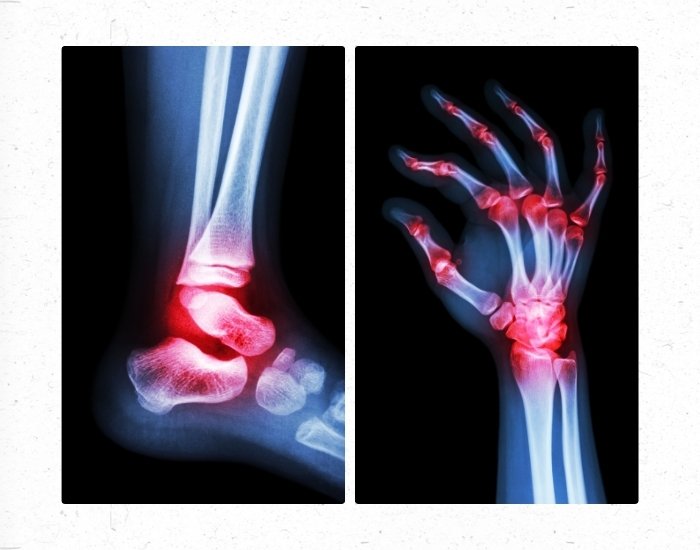 Arthritis and Rheumatoid Arthritis