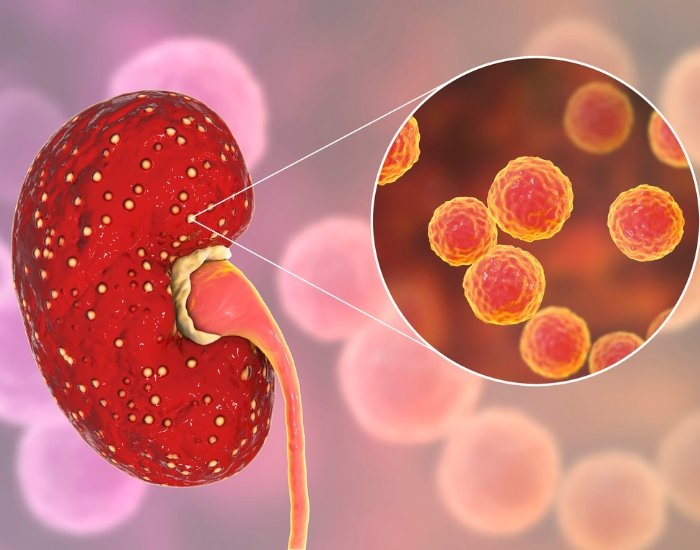 Kidney Infections and Symptoms
