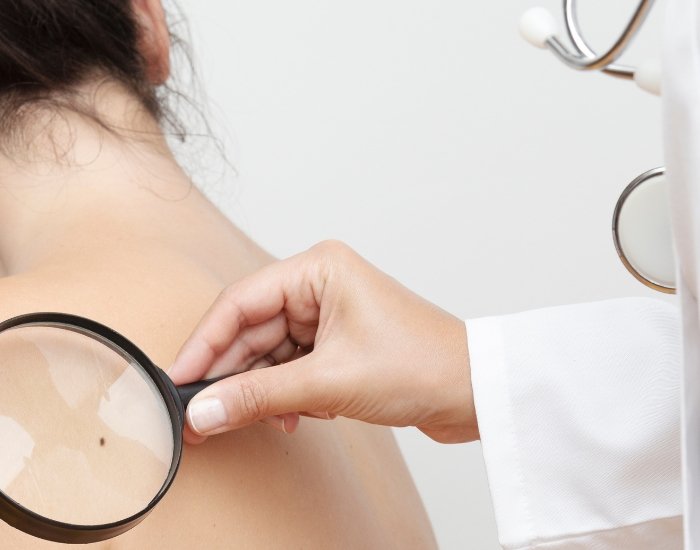 Skin Cancer